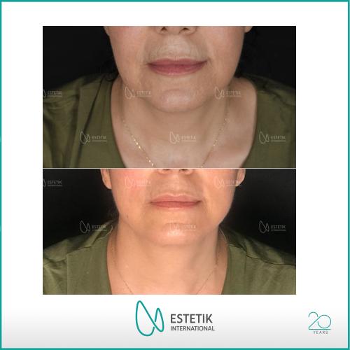 Before after photos of our patients 4